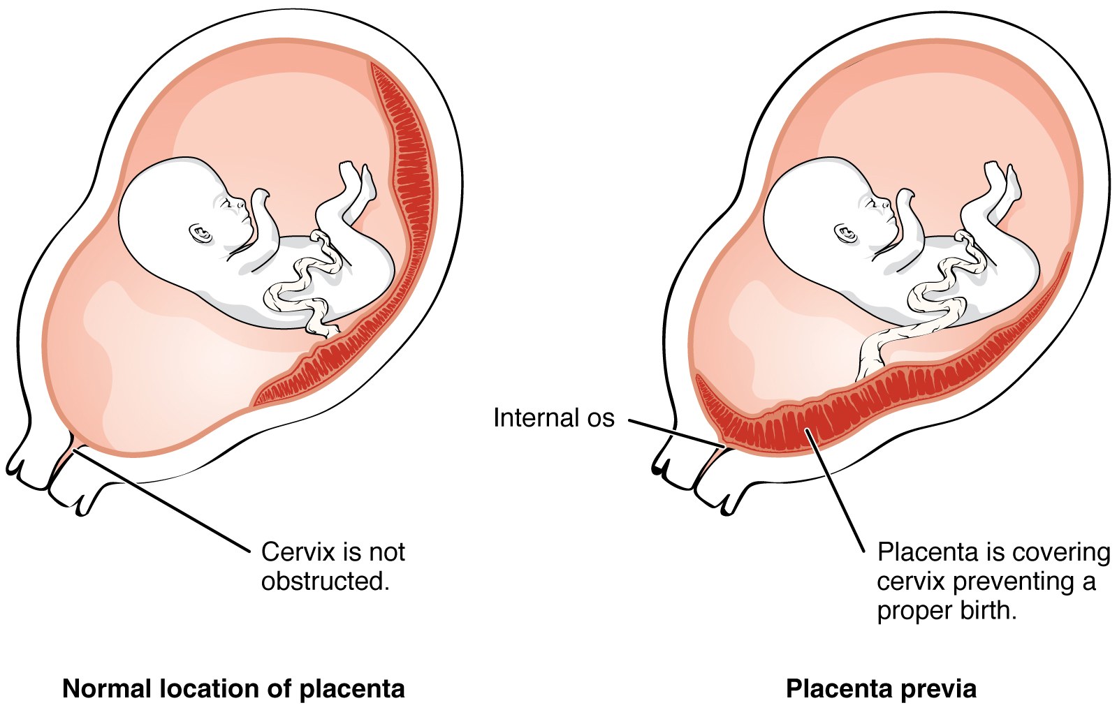 Comparação entre a implantação normal da placenta no corpo uterino e a placenta prévia, cobrindo o orifício interno do colo uterino
