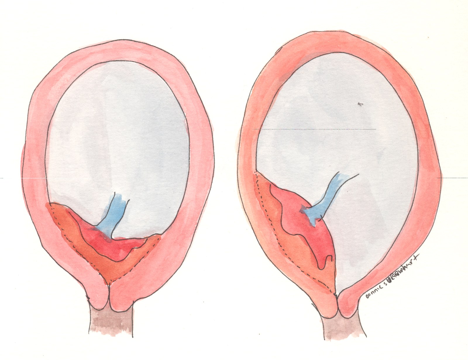 Desenhos anatômicos da placenta prévia total, à esquerda, e parcial, à direita