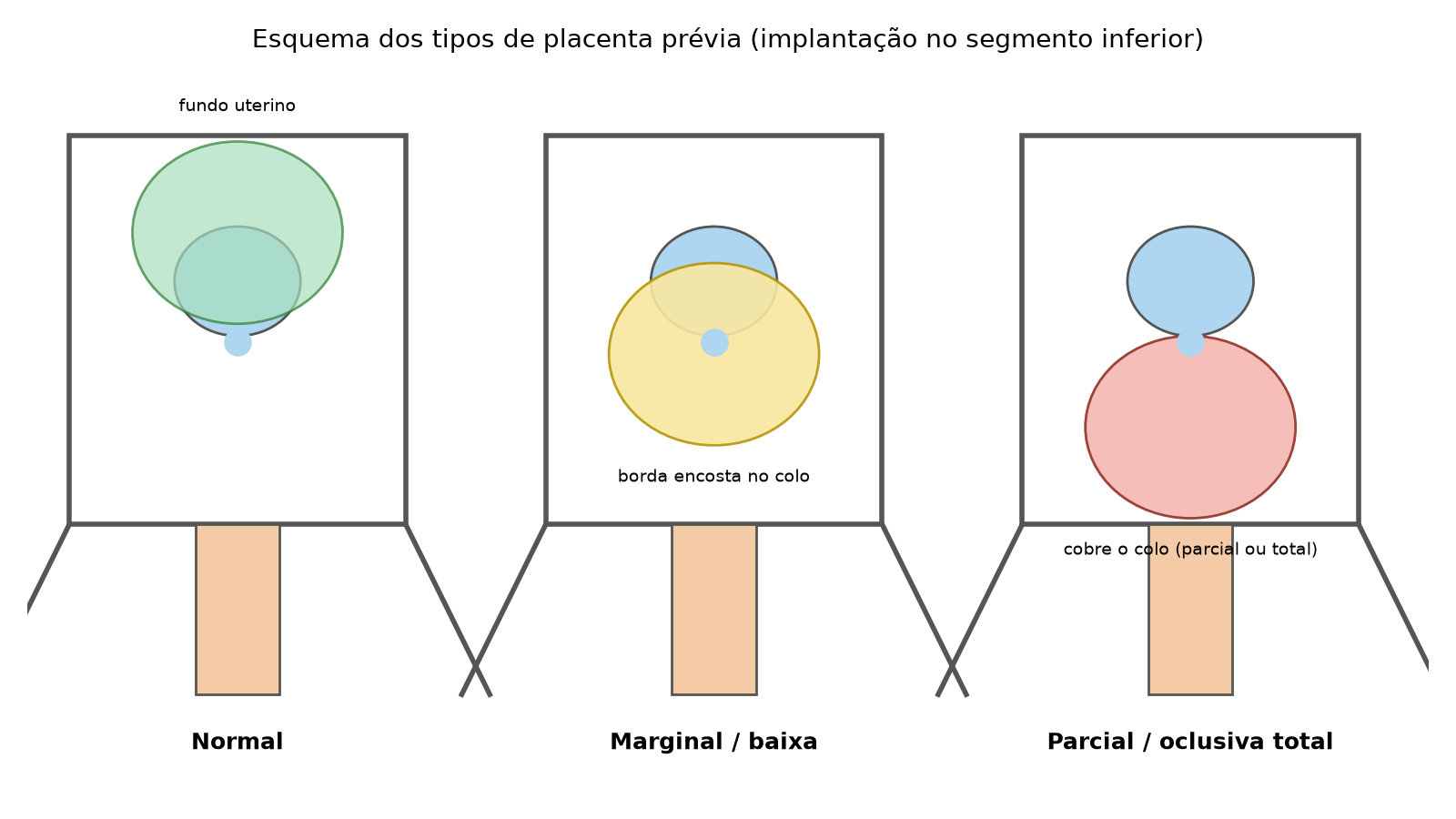 Esquema dos tipos de placenta prévia: normal, marginal/baixa e parcial/oclusiva total